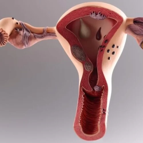 Cancerul uterin sau cancerul endometrial