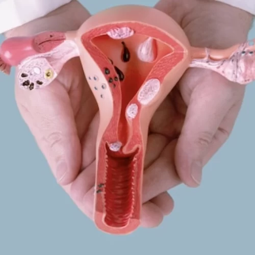 Uterine Fibroid Surgery