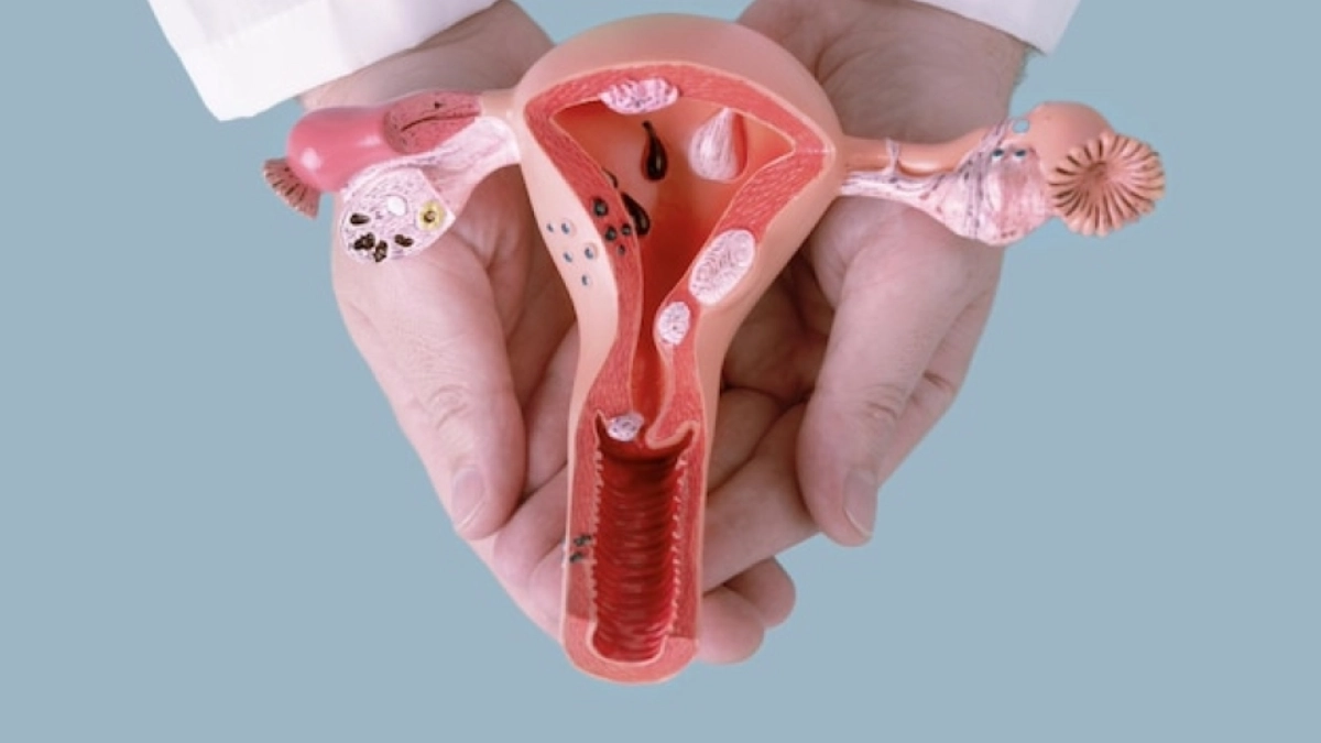 Uterine Fibroid Surgery