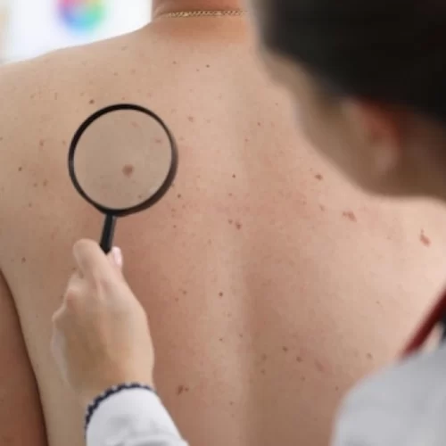 skin-cancer-treatment-in-turkey Skin Cancer Treatment in Turkey