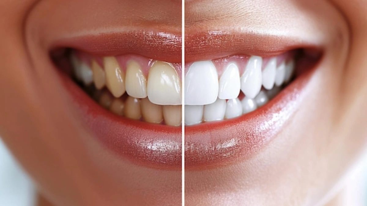 Teeth Whitening in Turkey