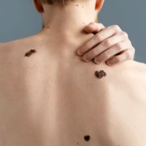 skin-cancer-guide Skin Cancer