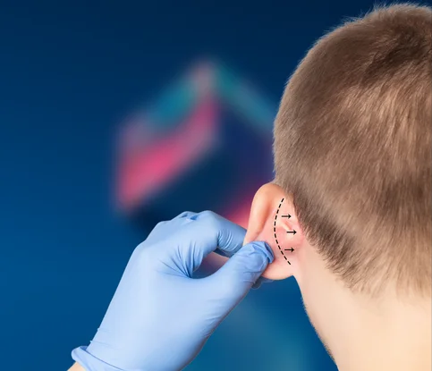 Otoplasty