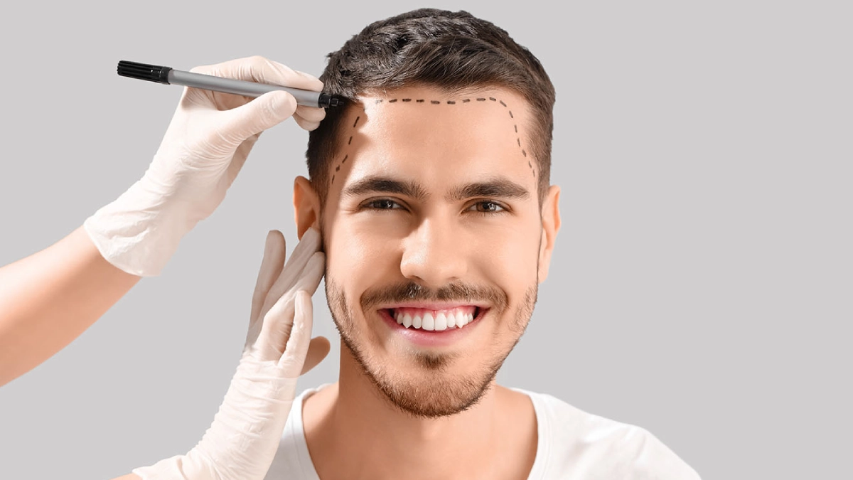 ۸ مزیت تکنیک کاشت موی FUE