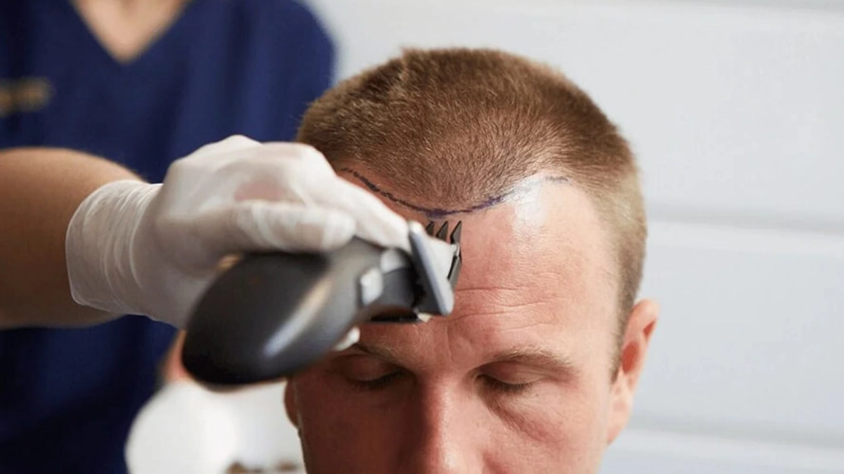 همه چیز درباره کاشت موی DHI