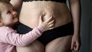 alles ueber die mami makeover-operation