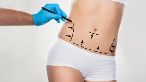 Liposuktion oder Bauchdeckenstraffung?