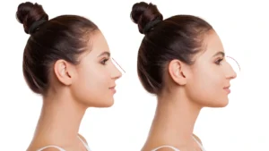 Nasen-OP: Die ultimative Anleitung