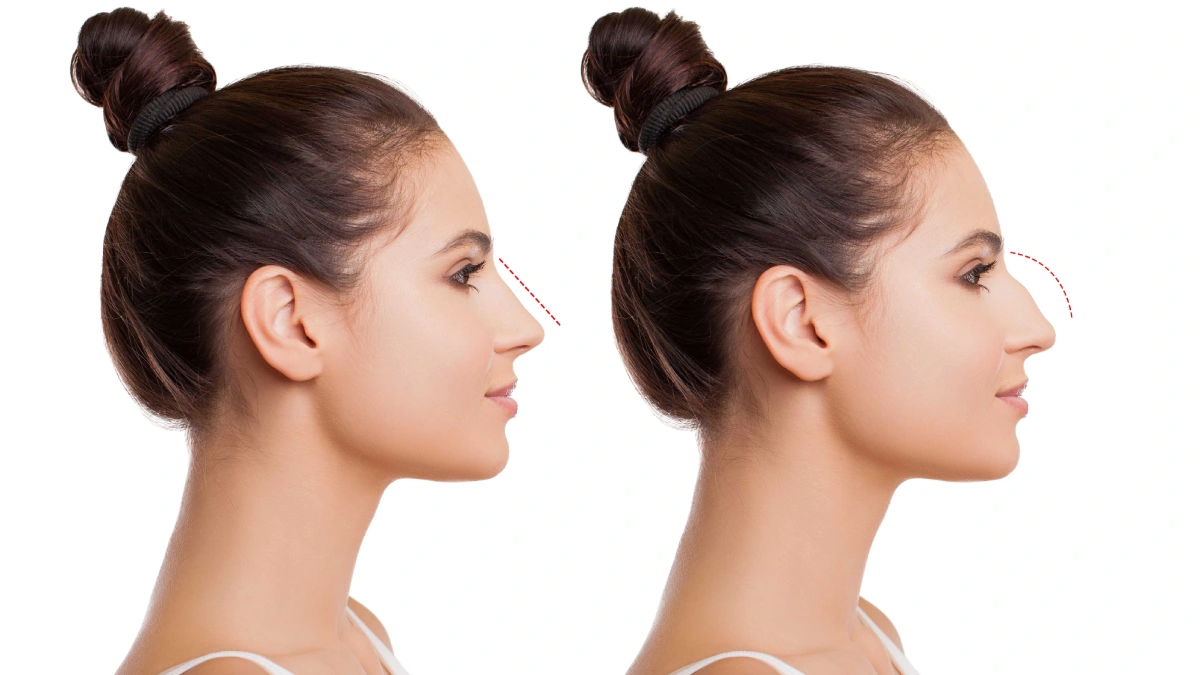 Nasen-OP: Die ultimative Anleitung