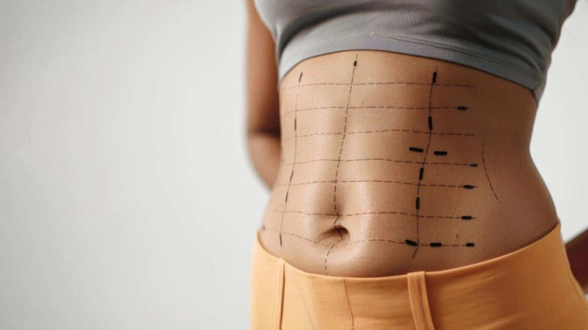 Tummy Tuck Mituri şi. Fapte