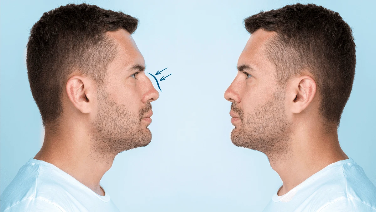 هزینه عمل بینی در ترکیه