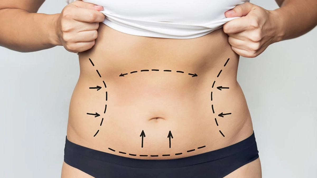 همه چیز درباره عمل لیپوساکشن در ترکیه