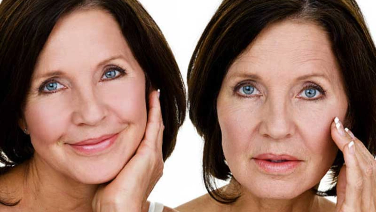 Vorteile eines Facelifts in der Türkei