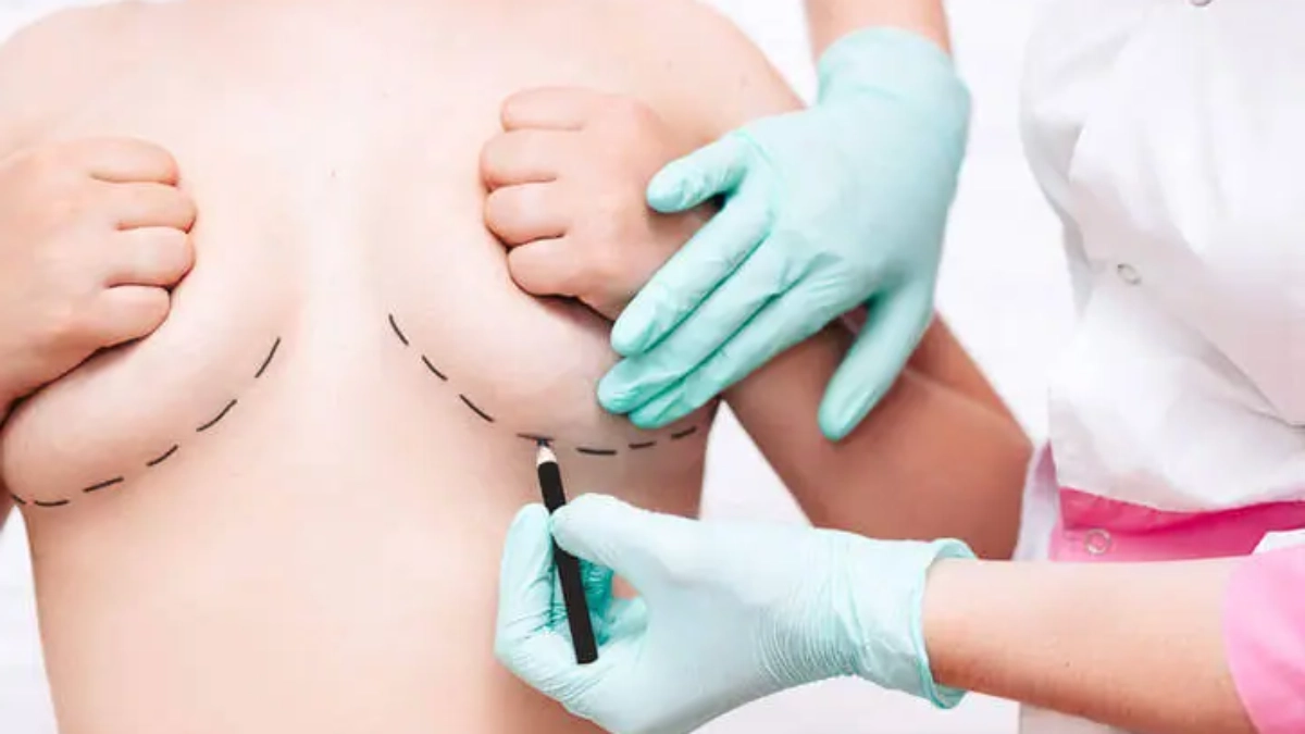 Alles über die ästhetische Brustoperation in der Türkei