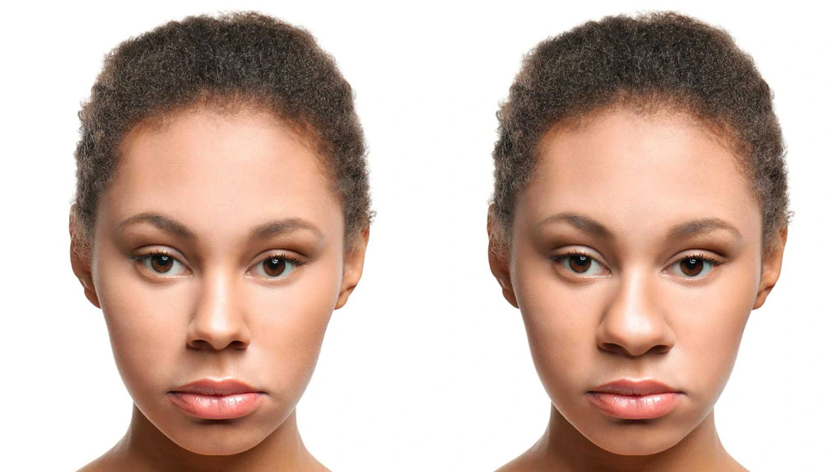 Natürliche Nasenoperation in der Türkei: 6 Wichtige Tipps