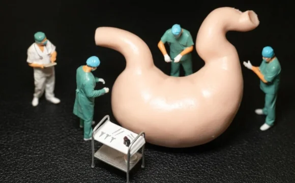 Stomach Stapling Surgery in Turkey