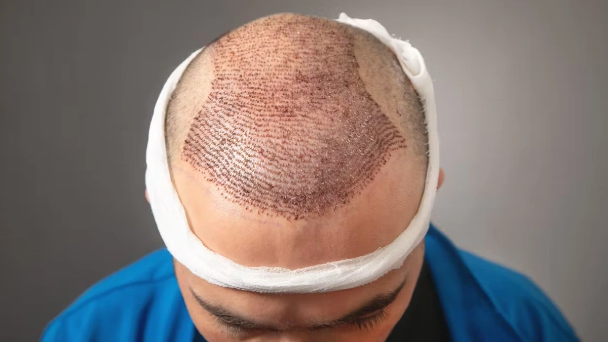 ۷ سوال مهم درباره کاشت مو طبیعی | هر آنچه باید بدانید