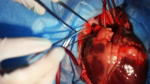 Open Heart Surgery in Turkey