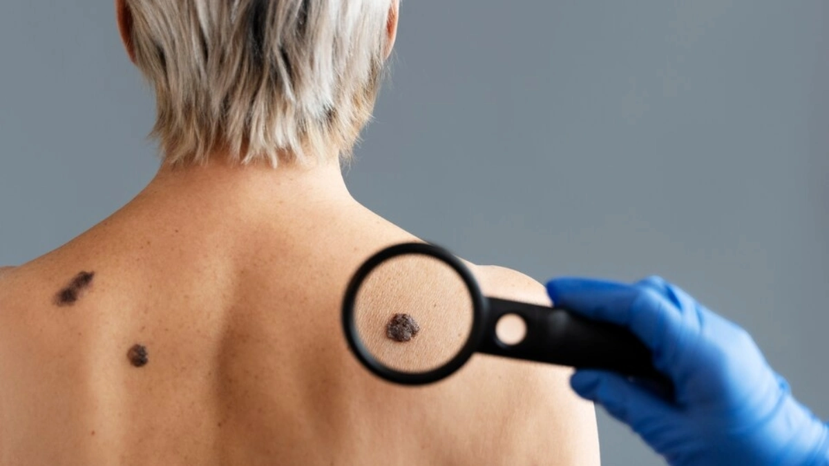 Tratamentul melanomului în Turcia