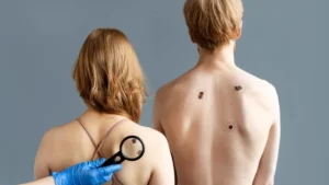 Лечение на меланом в Турция