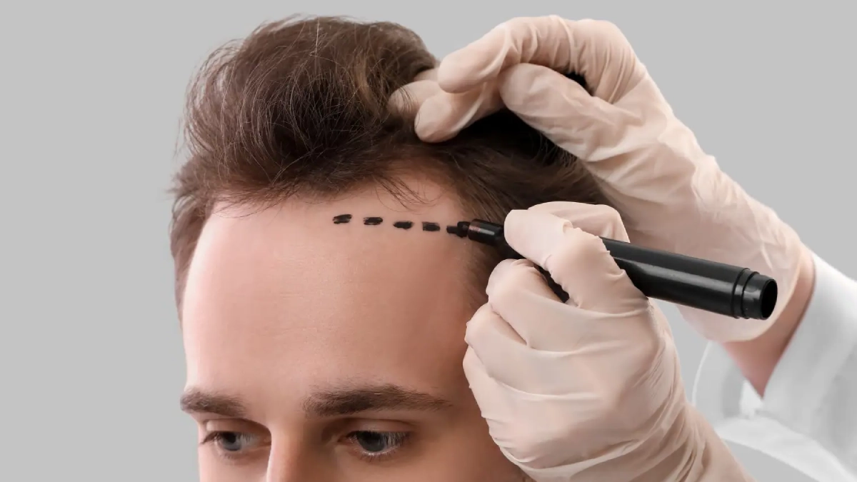5 Missverständnisse über Haartransplantationen