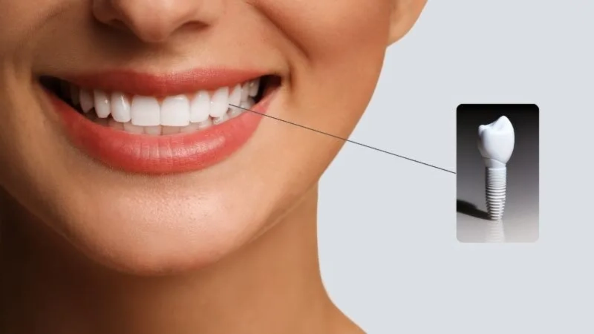 ایمپلنت فوری دندان در استانبول