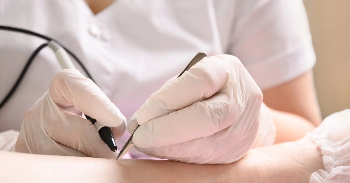 cımbızlı iğneli epilasyon yöntemi