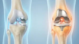Partial vs. Total Knee Arthroplasty in Turkey