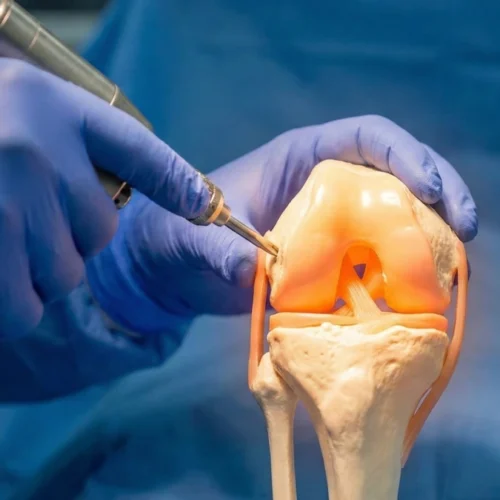 Revision Knee Replacement in Turkey