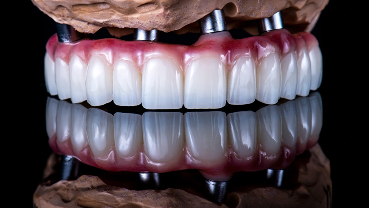 انواع ایمپلنت دندان در استانبول