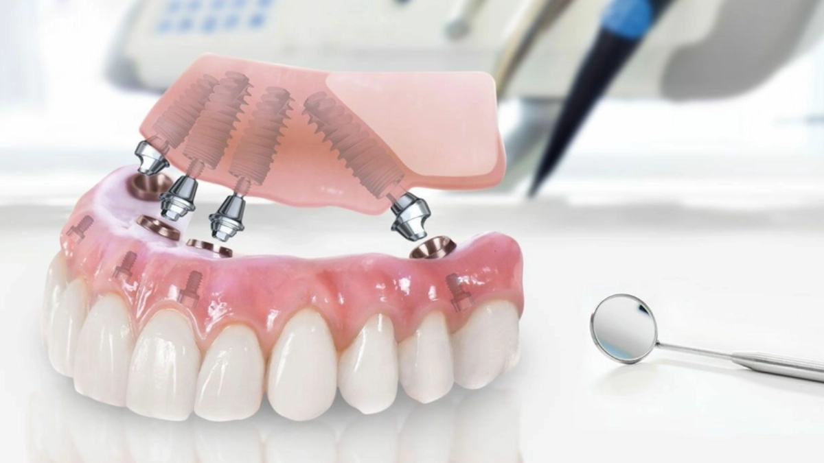 ایمپلنت دندان ترکیه در استانبول