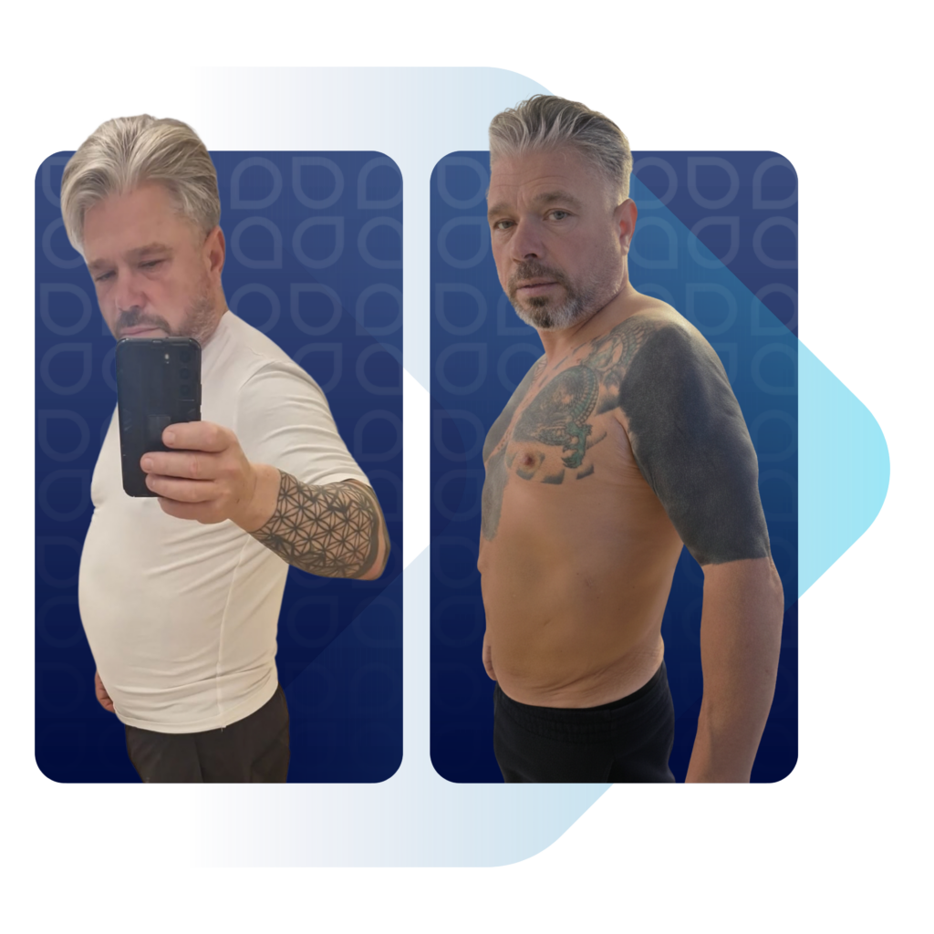 Obezite kilo kaybı sürecinde before after fiziksel değişim.