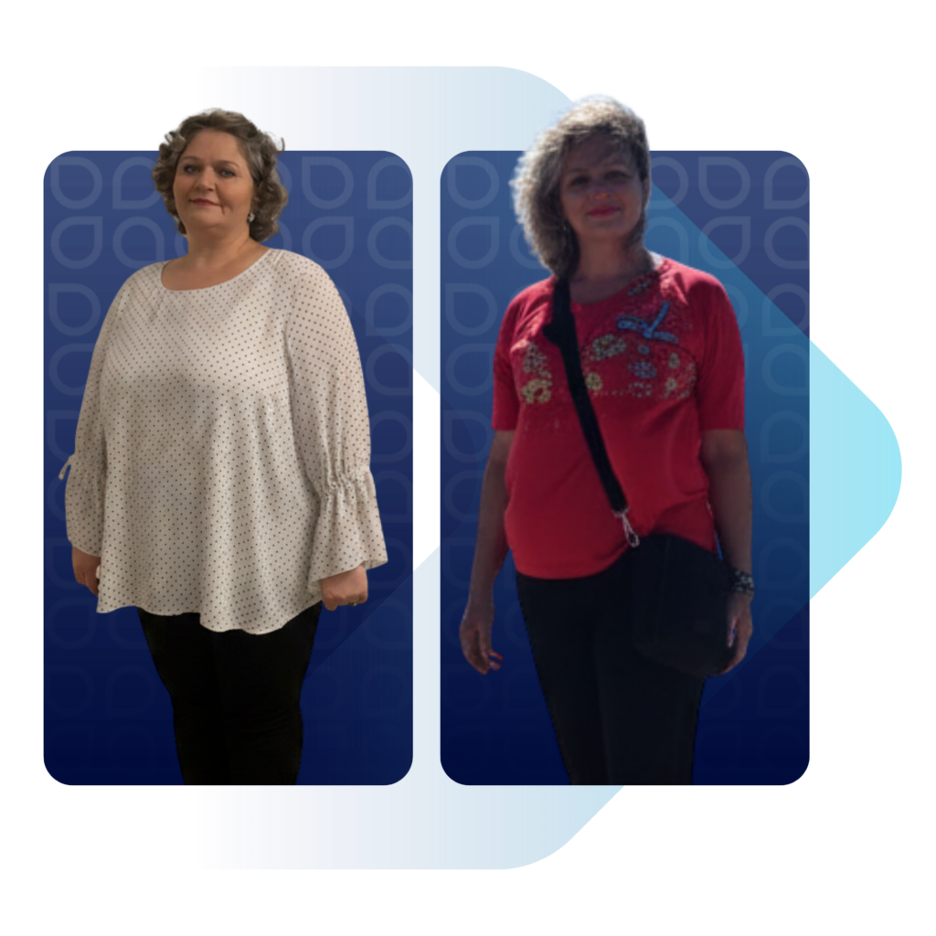 Obezite kilo kaybı sürecinde before after fiziksel değişim.