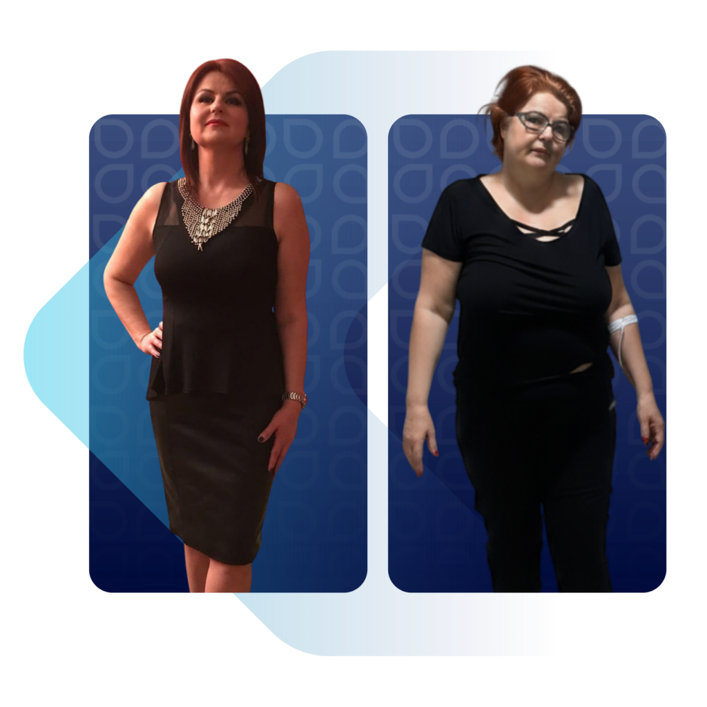 Obezite kilo kaybı sürecinde before after fiziksel değişim.