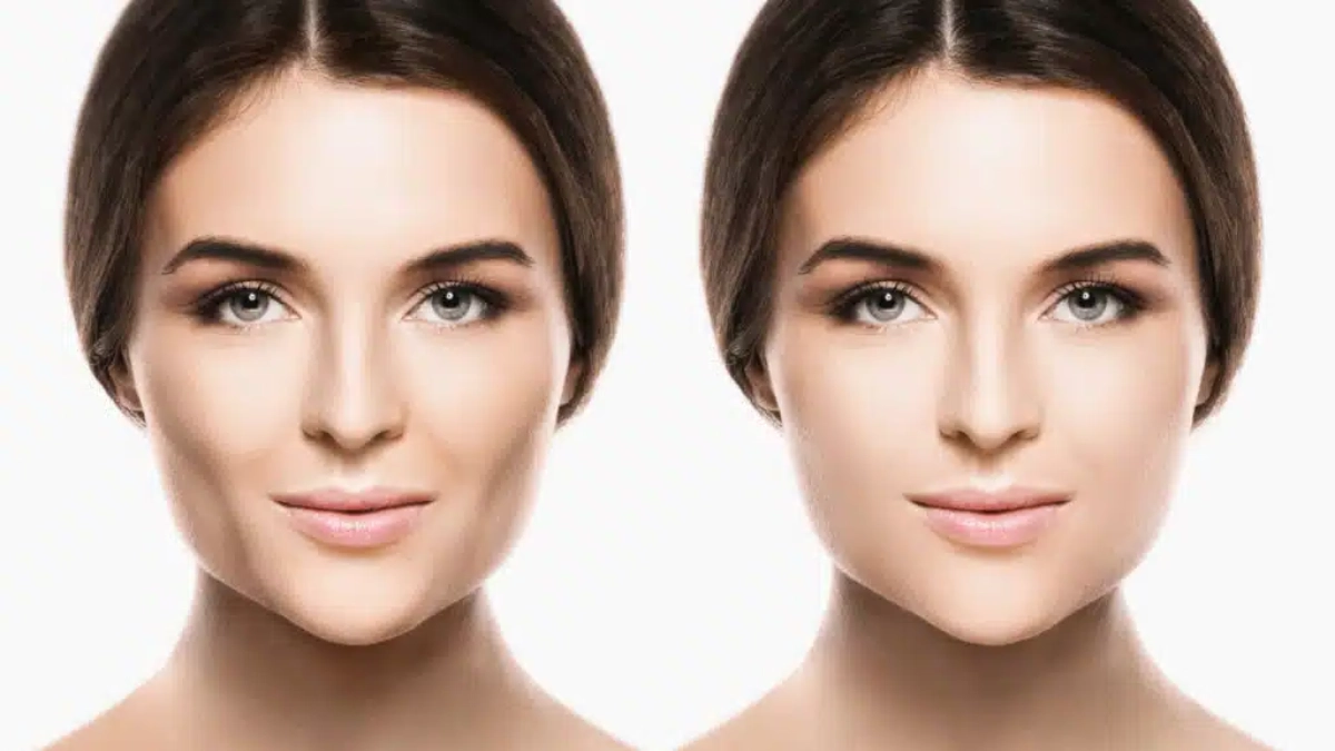 پیچکتومی برداشتن چربی گونه در ترکیه