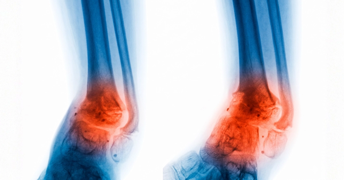 Osteomyelitis treatment in Turkey